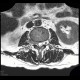 Lung cancer, infiltration of lung wing, metastasis in neuroforamina: MRI - Magnetic Resonance Imaging